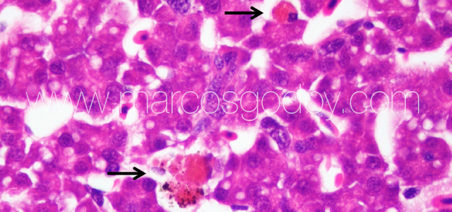 Liver melanomacrophahes center VIII