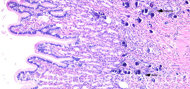 Calcinosis gastrica VII