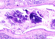 calcinosis renal small