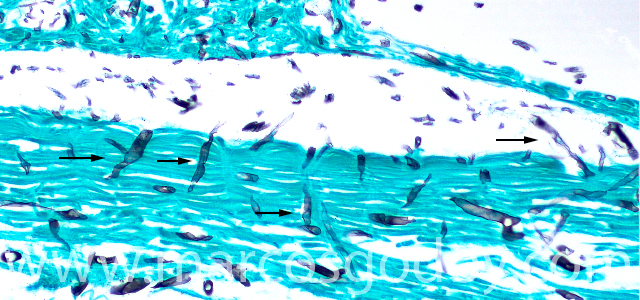 Dermatisis fungica piel Grocott 200X VI