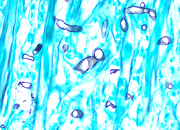 Dermatisis fungica piel Grocott smallI