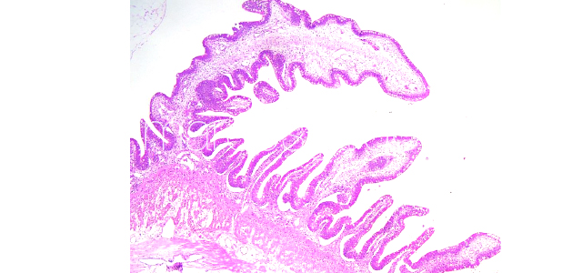 Gut edema histopathology I