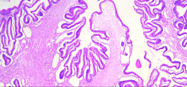 Gut edema histopathology VI
