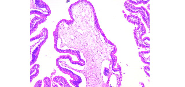 Gut edema histopathology VIII