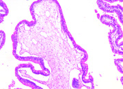 Gut edema histopathology small