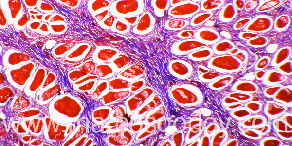 Muscle fibrosis TM 10X V