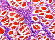Muscle fibrosis small