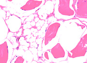 Muscle esteatosis small