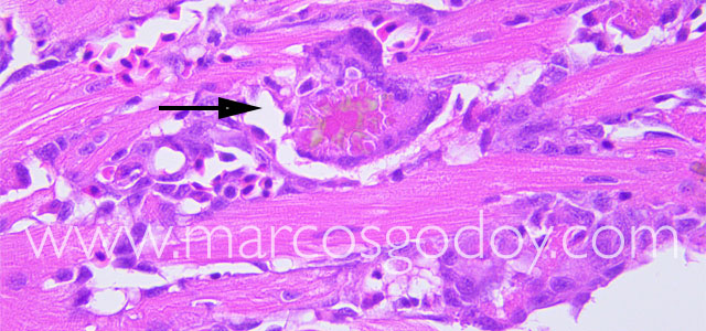 Miocarditis granuloma III