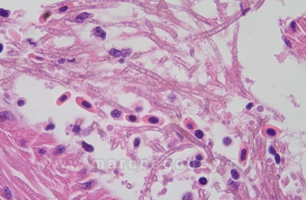 Miocarditis Infecciosa por Exophiala salmonis: Caso en salmón del Atlántico (Salmo salar)