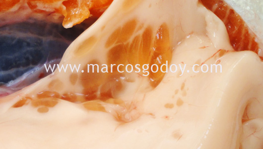cyst-3 cyst-3