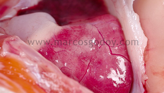 epicarditis-3