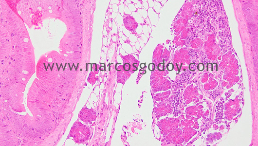 pancreatitis-1