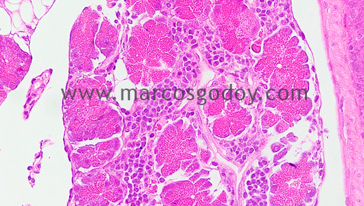 pancreatitis-2