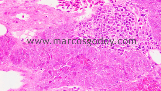 pancreatitis-4