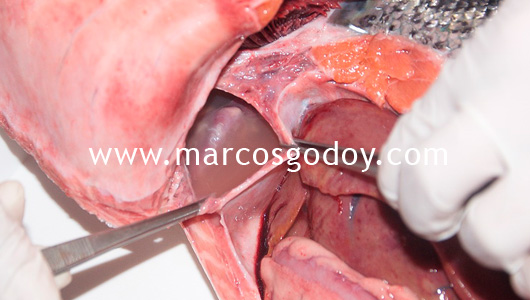 hydromericardio-pericarditis-ii