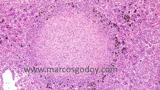 granuloma-ib