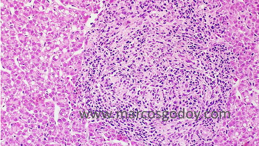 granuloma-ii-b