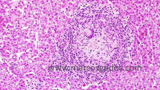 granuloma-iiib