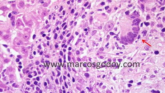 granuloma-ivb