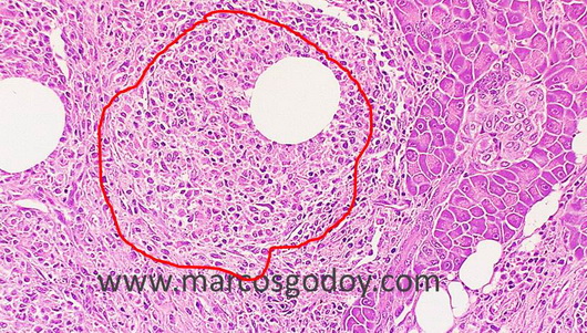 granuloma-vb