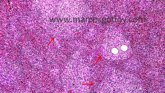 granuloma-vib31