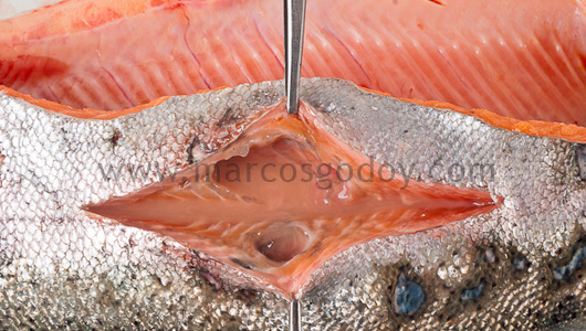 abscess-v