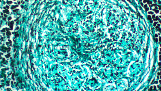 hepatitis-granulomatous-i