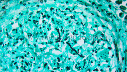 hepatitis-granulomatous-ii