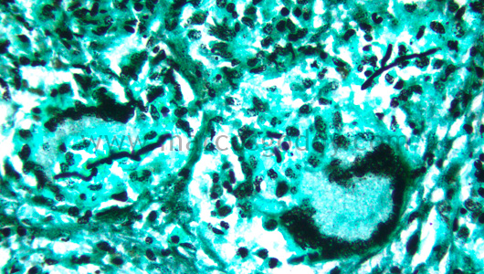 hepatitis-granulomatous-iii