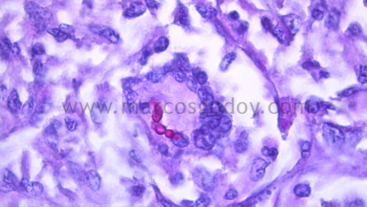 hepatitis-granulomatous-iv
