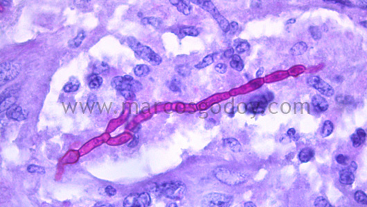 hepatitis-granulomatous-v