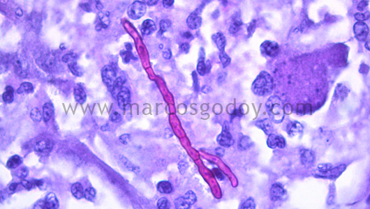 hepatitis-granulomatous-vi