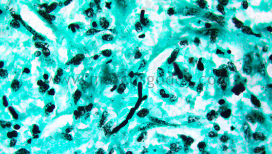 hepatitis-granulomatous-vii