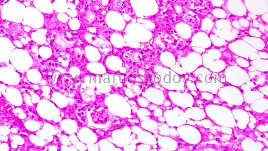 steatonecrosis-i