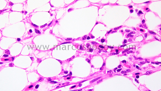 steatonecrosis-ii1