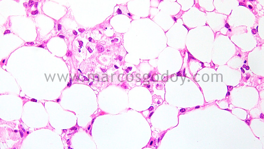 steatonecrosis-iii