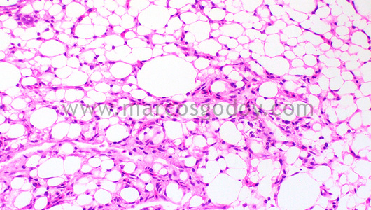 steatonecrosis-iv1