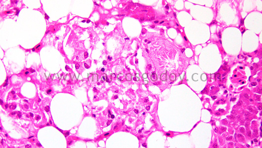 steatonecrosis-v