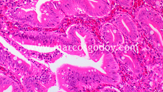 enteritis-i1 enteritis-i1