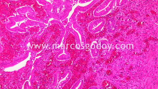 enteritis-ii enteritis-ii
