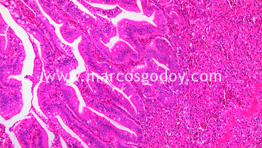 enteritis-v enteritis-v