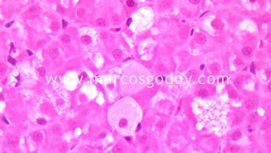 ground-glass-hepatocyte-ii