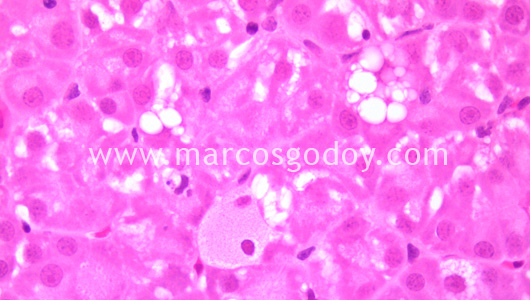 ground-glass-hepatocyte-iv