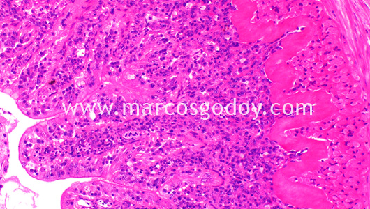 leukemia-iv