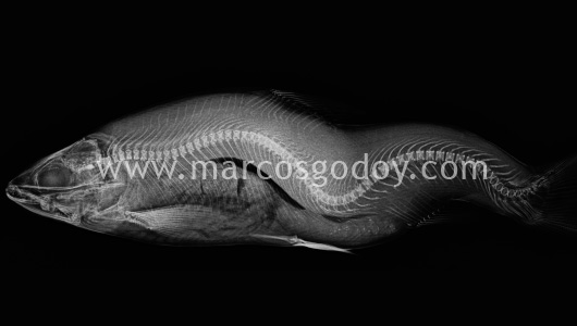 scoliosis-i