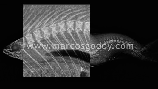 scoliosis-ii