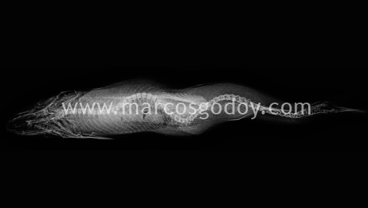 scoliosis-iii