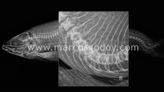 scoliosis-iv