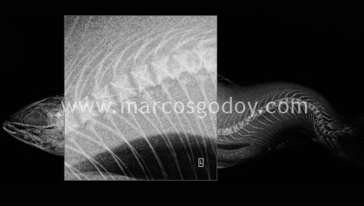 scoliosis-ix